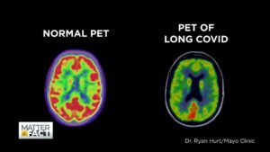 COVID long haul pet scan